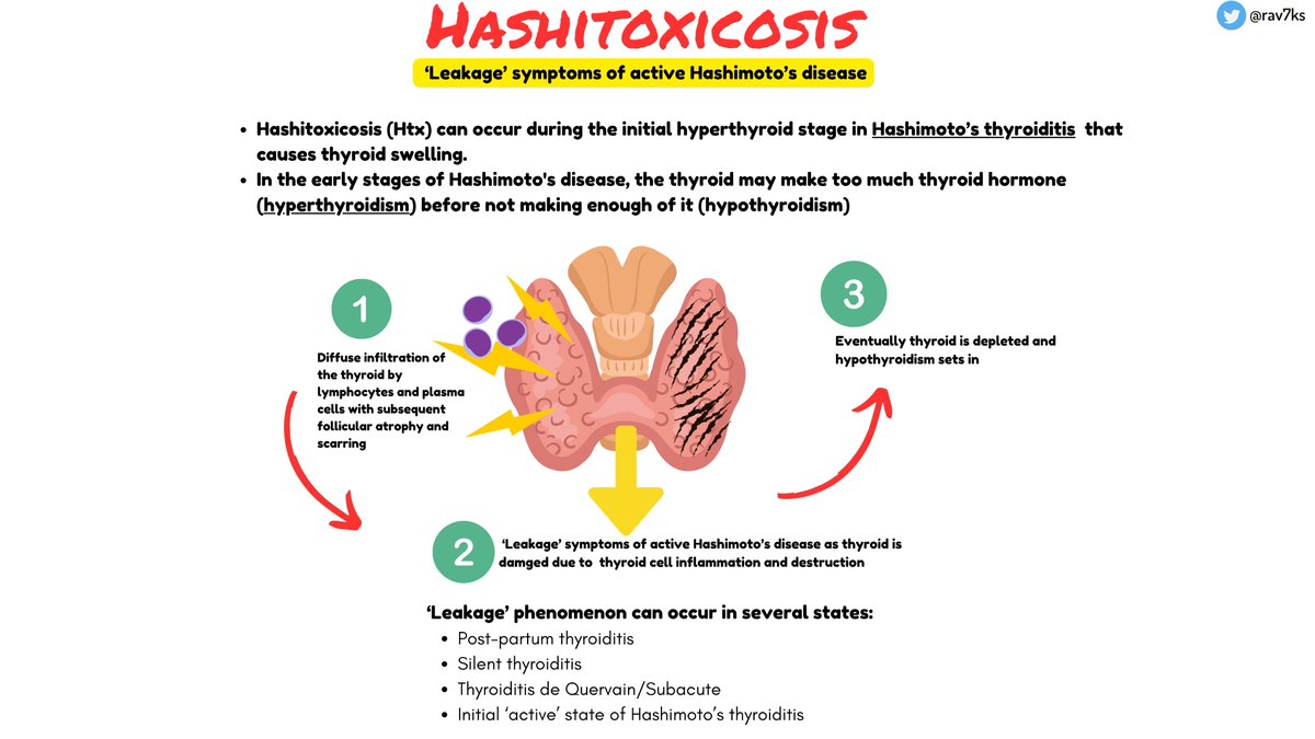 'Hashitoxicosis' 2 ways it can happen. Learned about this during a discussion with @ASanchez_PS on VMR. 1. Leakage phenomena: In Hashimoto's -thyroid cell inflammation/destruction can cause therelease of thyroid hormone causing a transient ⬆️thyroid state. This can last 1-2 mos.