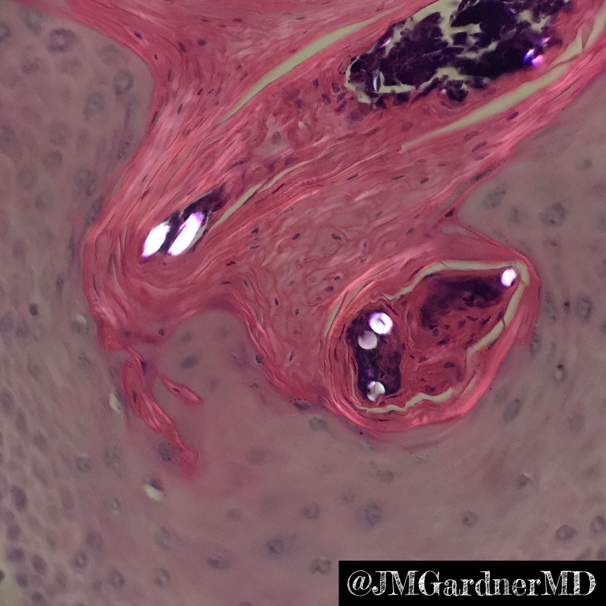 Skin papule. What is happening here? What is the name of the phenomenon? Pic 3 is polarized...what are the white glowing structures? Answer & explanation: kikoxp.com/posts/9996 #pathology #pathologists #pathTwitter #dermpath #dermatology #dermatologia #dermtwitter