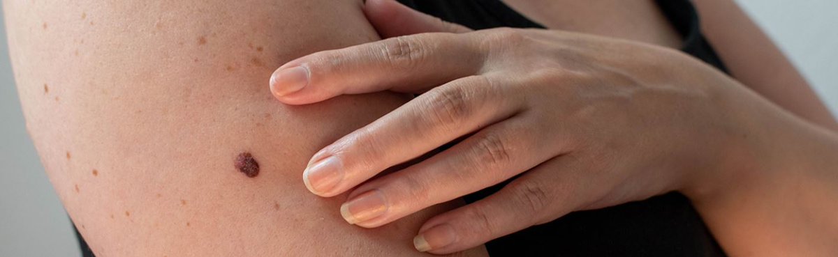 Harley Street Health District (@harleysthealthd) on Twitter photo As we welcome the warmer weather and #SunAwarenessWeek, it’s important to remember that while the sun may feel great, it can also pose significant risks to our skin.
Dr Ariel Haus of <a href="/Dr_Haus/">Dr Ariel Haus</a> Dermatology on #HarleyStreet discusses more on our website: shorturl.at/xNV23 As we welcome the warmer weather and #SunAwarenessWeek, it’s important to remember that while the sun may feel great, it can also pose significant risks to our skin.
Dr Ariel Haus of <a href="/Dr_Haus/">Dr Ariel Haus</a> Dermatology on #HarleyStreet discusses more on our website: shorturl.at/xNV23