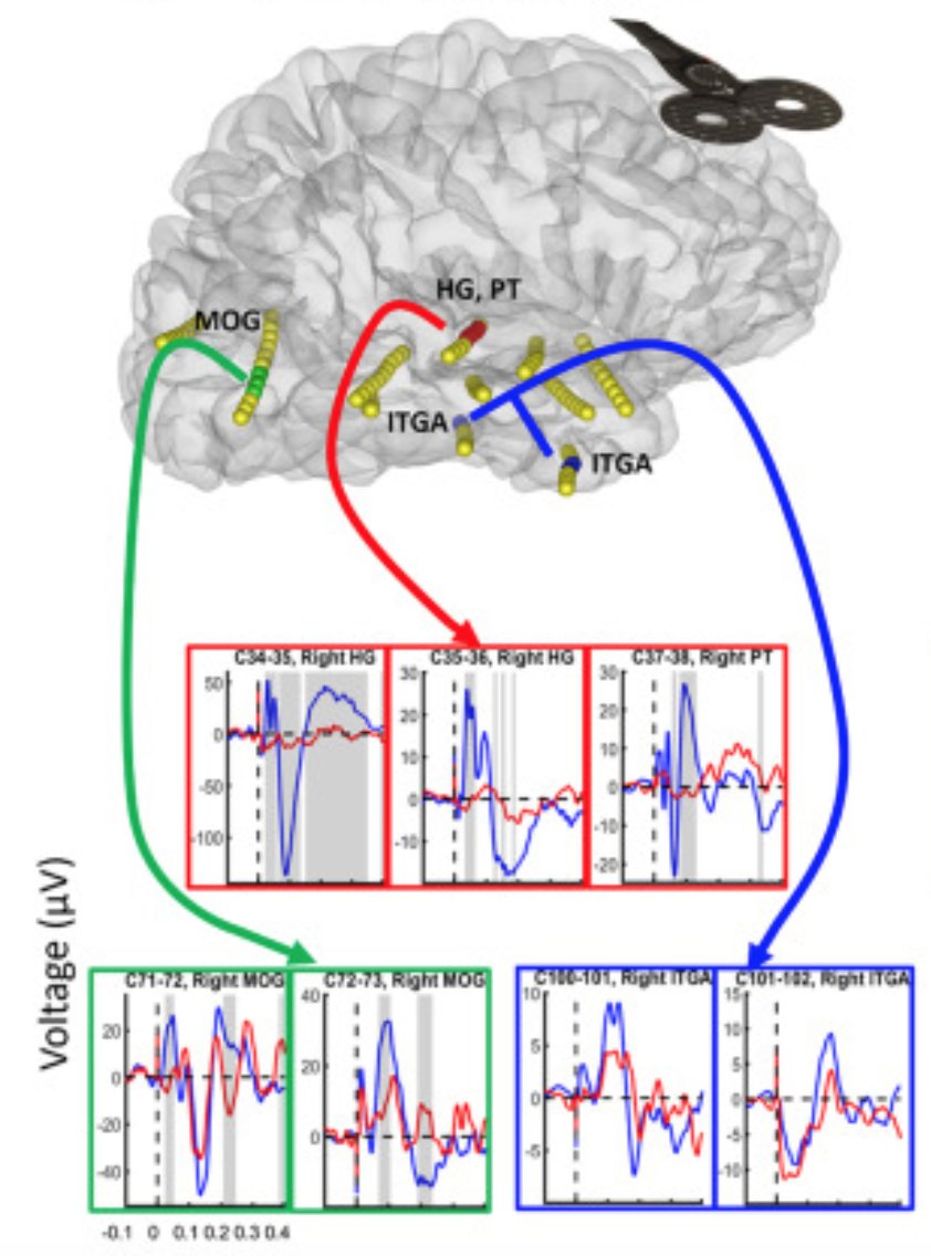 Auditory masking of TMS has a clear beneficial effect. Cleans artifact signal in primary auditory cortex, as one would expect, but also changes the iEEG response in other brain areas. Out today in @brainstimj by @NickTrapp13, Eric Tsang and team. sciencedirect.com/science/articl…