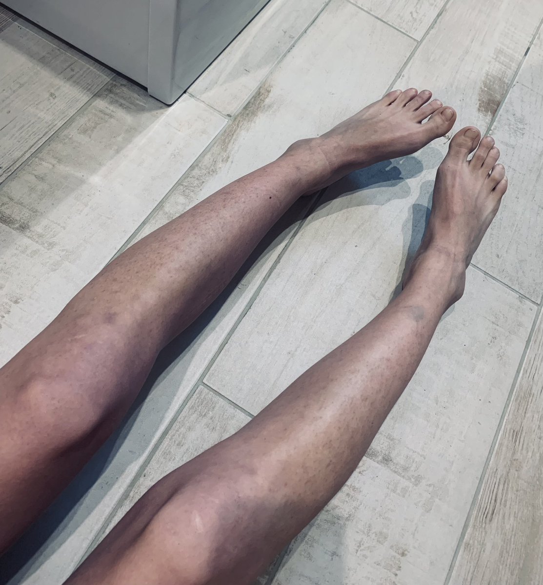 Aujourd’hui c’est une journée très difficile 😞 Je ne peux plus marcher , mes jambes tremblent et je souffre énormément… J’ai du mal à comprendre pourquoi mes jambes sont dans cet état depuis les injections ! Jambes violettes, reflux dans les veines saphènes,veines