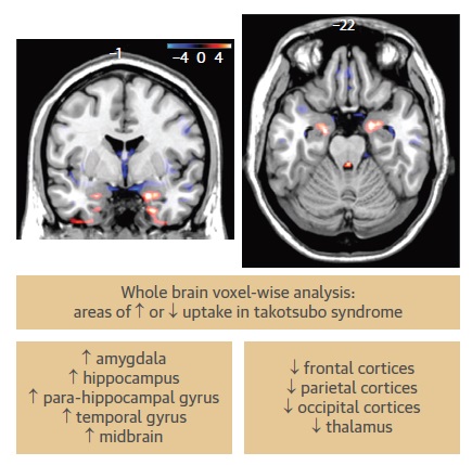 Patients with Takotsubo Syndrome 🫀 have a distinct brain🧠 metabolism featured by increased activity of those brain areas involved in emotional circuits: a case control 18-F FDG PET study. 

Our manuscript pubblished for @JACCJournals #JACCIMG 

📚🆓👉authors.elsevier.com/a/1j0iB,i2Xryc…