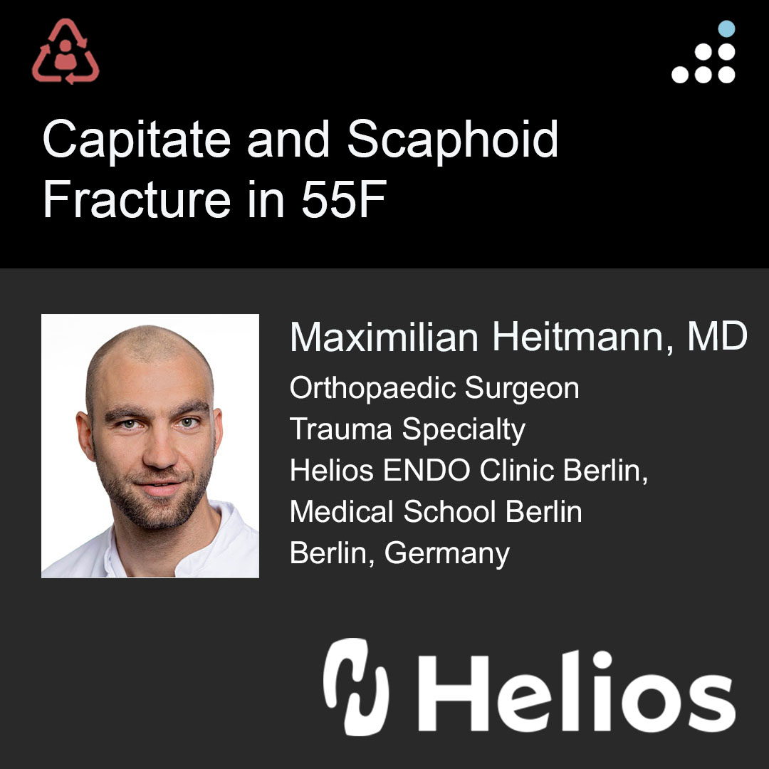 Here are intra-op & post-op images of yesterday's case by Dr. Maximilian Heitmann and Helios ENDO Clinic Berlin, Medical School Berlin.

CAPITATE AND SCAPHOID FRACTURE IN 55F

PROCEDURE: 
SCAPHOID: CRIF WITH PERCUTANEOUS RETROGRADE HERBERT SCREW 
CAPITATE: ORIF WITH MINI-PLATE