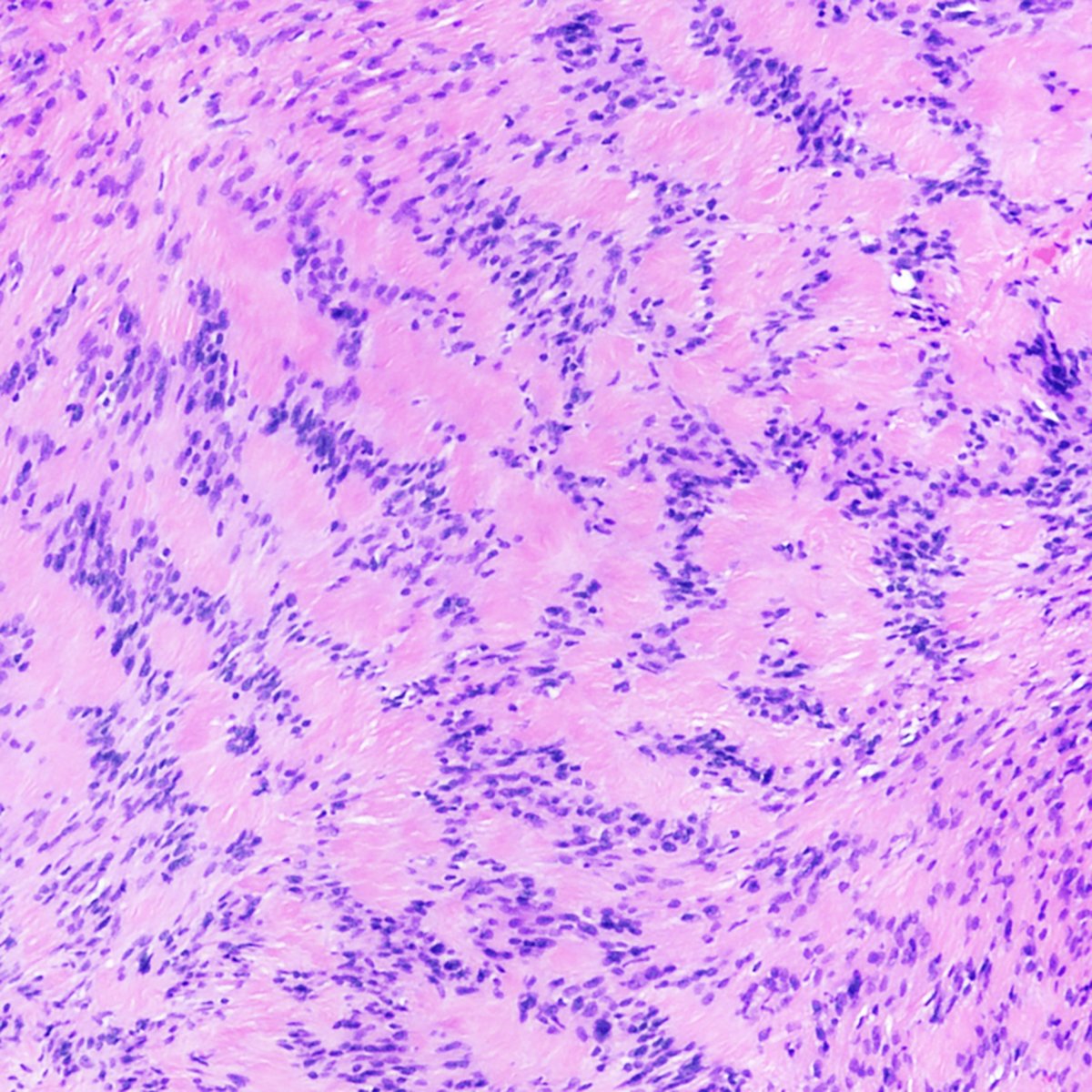 One image is all you need of this paraspinous tumor. Diagnosis? #pathology #neuropath #pathtwitter