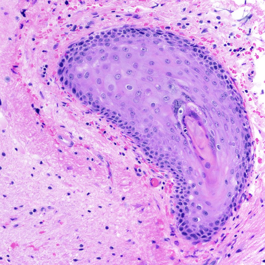 Here's something you don't see every day: an epidermal inclusion cyst growing into brain tissue. #pathology #neuropathology #PathTwitter