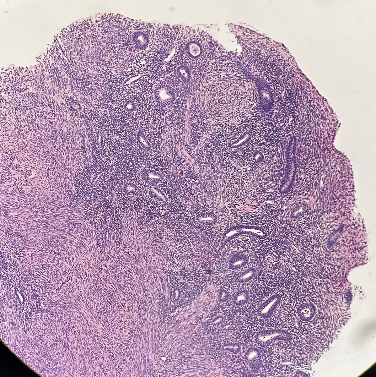 Path4People's tweet image. Sometimes you can get an endometrial polyp

Sometimes you can get an endocervical polyp

Sometimes you can get an endometrial/endocervical polyp (arising from the lower uterine segment)

Credit: Lisa Marinelli, MD

#pathagonia #path4people #gynpath #pathx #obgyn #pathtwitter