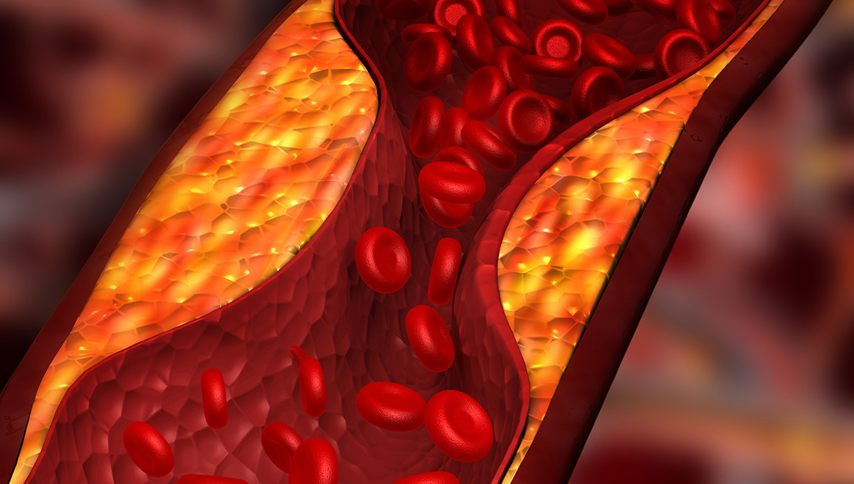 Atherosclerosis Progression May Share Traits With Tumor Growth dlvr.it/T6c3NR