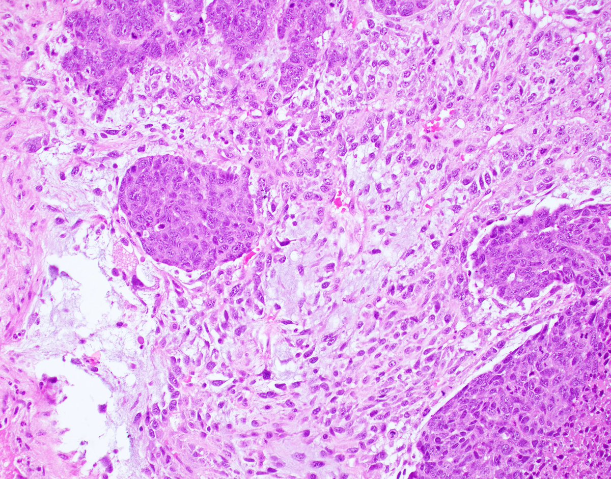 Really peculiar pattern of a rare neoplasm.

What is your diagnosis?

#breastcancer #breastpath #PathTwitter @wusm_pathology @washupathedu