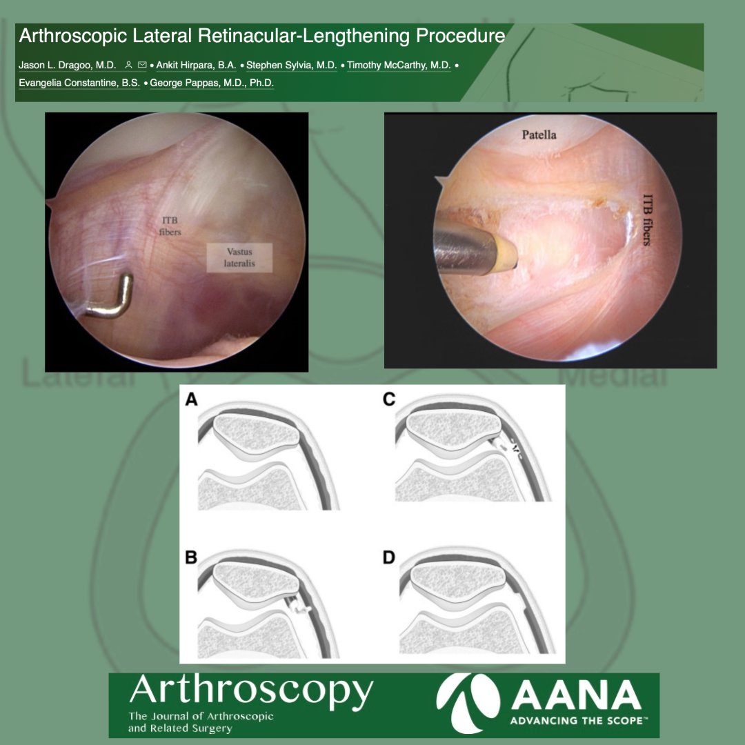 Check out this technique on arthroscopic lateral retinacular-lengthening for treatment of excessively tight lateral retinaculum! #Patellofemoral #KneeArthroscopy ow.ly/i6F650Rruik