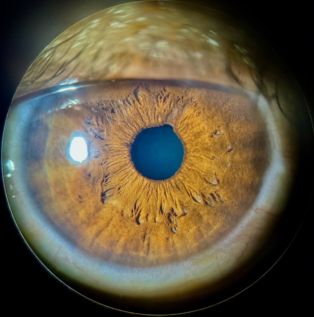 Dos bombas a punto de estallar en estos ojitos 💣 💣 👁️ #Ophthalmology #eyecare