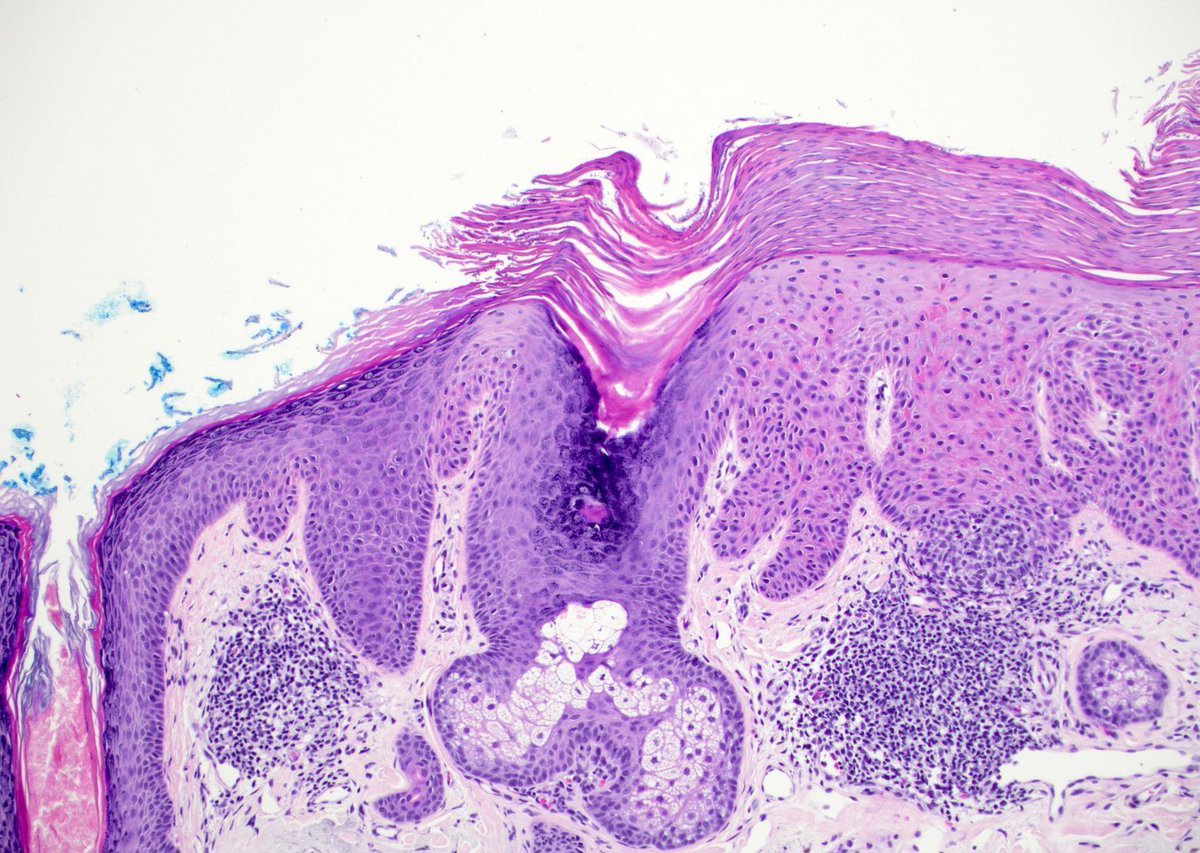 Why is R different from L in this pic? Both acanthotic, but different etiologies. Answer: kikoxp.com/posts/8828 (important #dermpath concept explained in 2 min!). #pathology #pathologists #pathTwitter #dermpath #dermatology #dermatologia #dermtwitter #usmle #medstudenttwitter