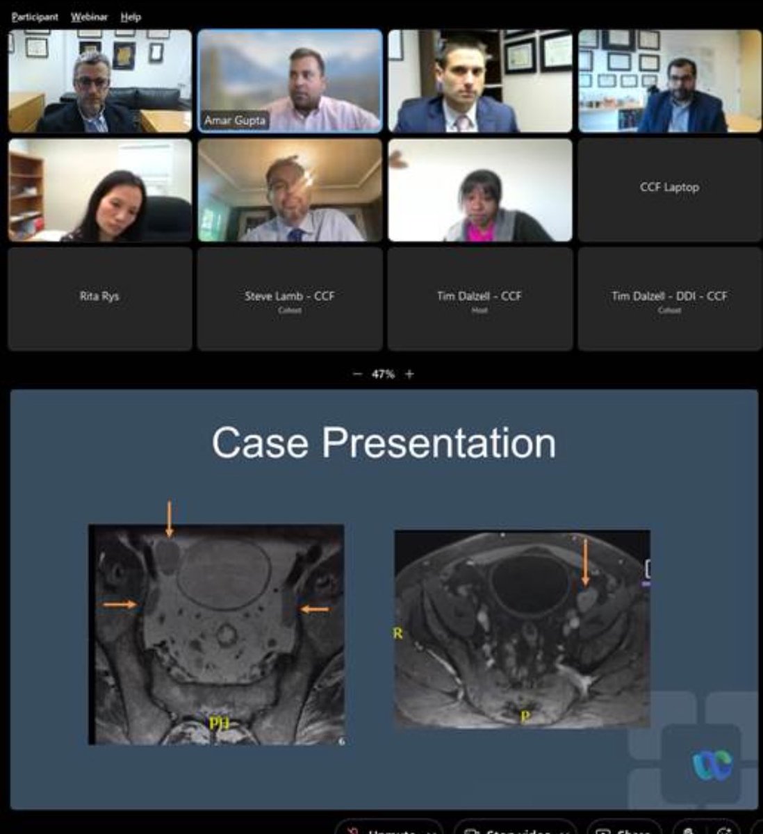 Excellent LIVE from @ClevelandClinic moderated by @davidrrosenmd and @ScottRSteeleMD discussing state of the art management of rectal cancer with lateral pelvic lymph node metastasis. @MRegueiroMD