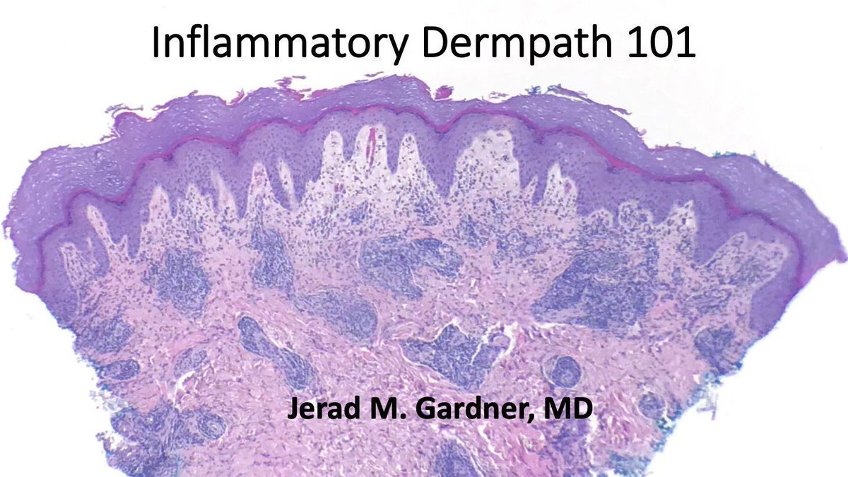 Inflammatory #dermpath 101 video: youtube.com/watch?v=afkIj-…. Spongiotic, vacuolar interface, lichenoid, psoriasiform...a practical algorithmic approach to rashes for #dermatology / #pathology trainees & general #pathologists. #pathTwitter #dermatologia #dermtwitter