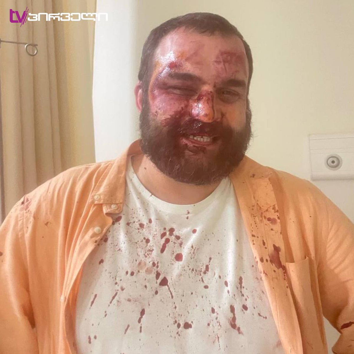 Dimitri Chikovani, the Secretary of Public Relations and Communications for opposition party @UNMGeorgia was severely beaten outside his home 📸 TvPirveli