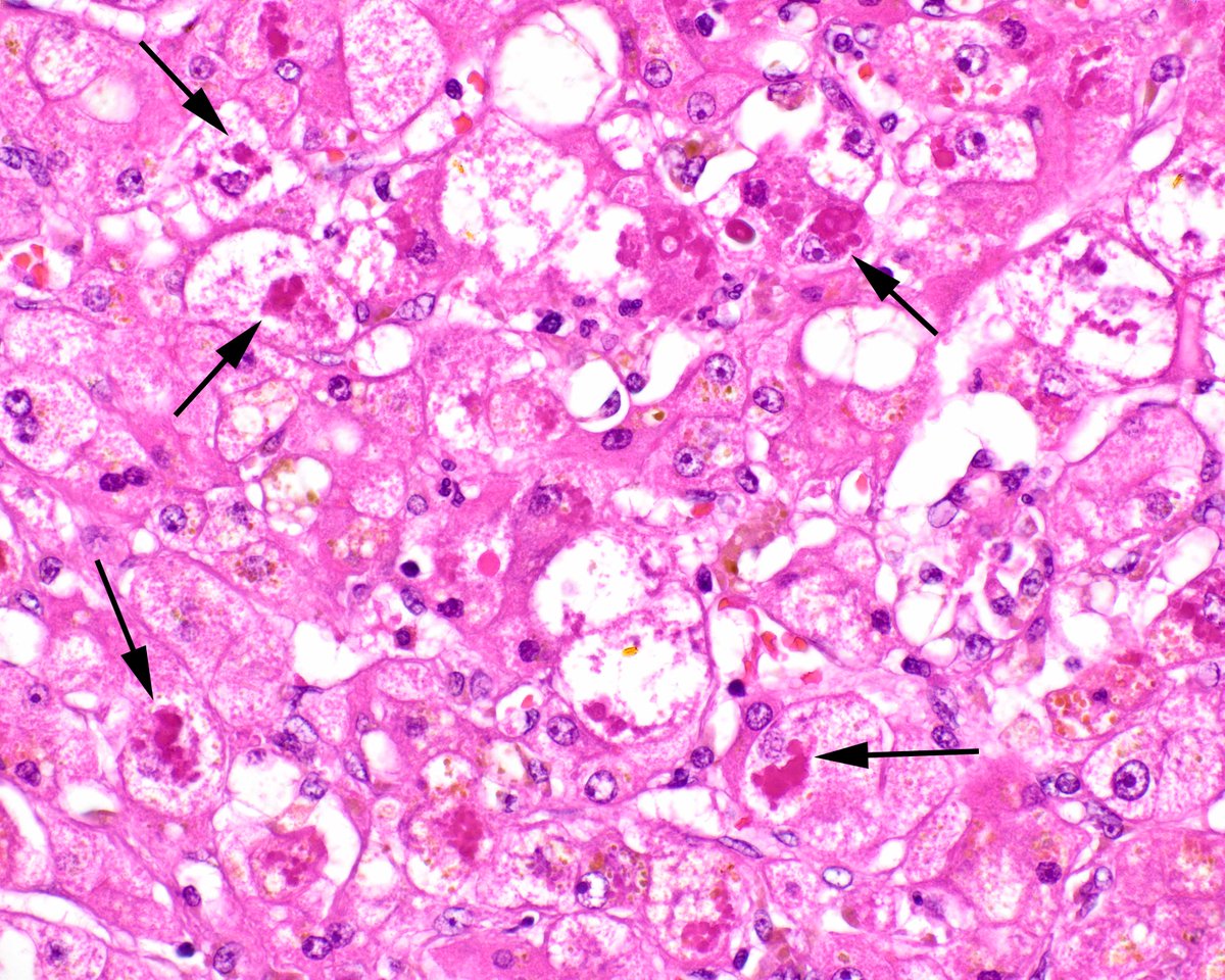 This is a hepatic explant from a relatively young patient who began drinking in the early teen years. The patient presented emergently with hepatic failure. The abundance of Mallory-Denk bodies (arrows) is shocking. #UMiamiPath