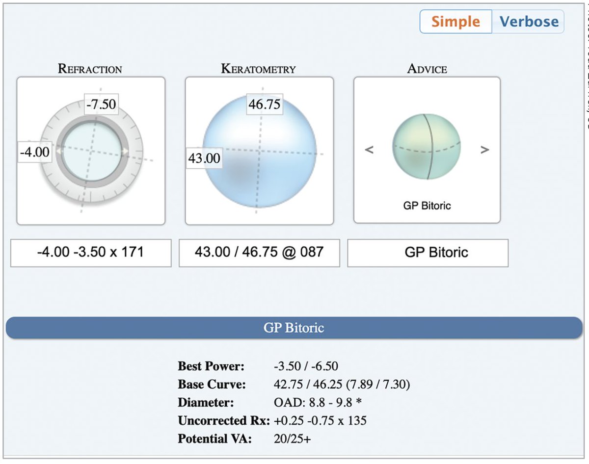 Empirical GP lens fitting not only saves chair time, but also eliminates concerns over whether a practice’s diagnostic lenses are properly disinfected and maintained. Read about recent advancements in empirical fitting of GP lenses: reviewofcontactlenses.com/article/empiri… #contactlens #cornea