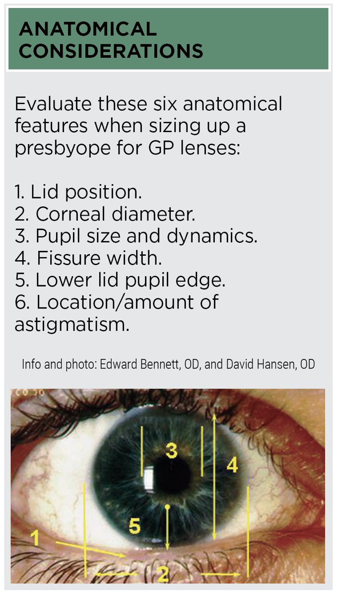 Patients with irregular corneas, higher or out-of-range prescriptions or greater visual demands are often the perfect candidates for rigid gas-permable contact lenses. Read about the lens options on the market in 2024: reviewofcontactlenses.com/article/empiri… #contactlens #cornea #vision