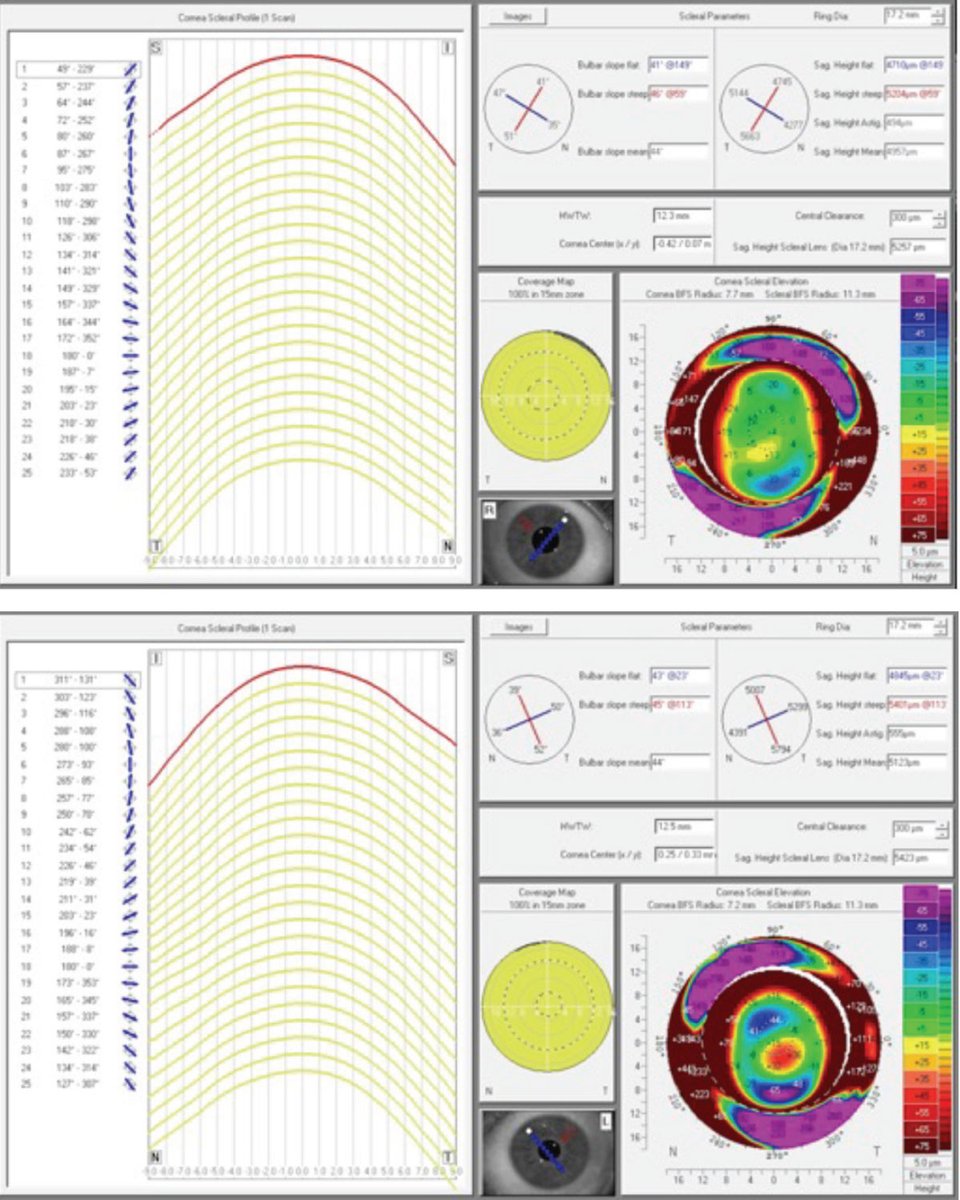 The case described in this edition of Fitting Challenges highlights the value of profilometry-based scleral lenses for pesky pinguecula: reviewofcontactlenses.com/article/scan-p… #contactlens #contactlenses #optometry