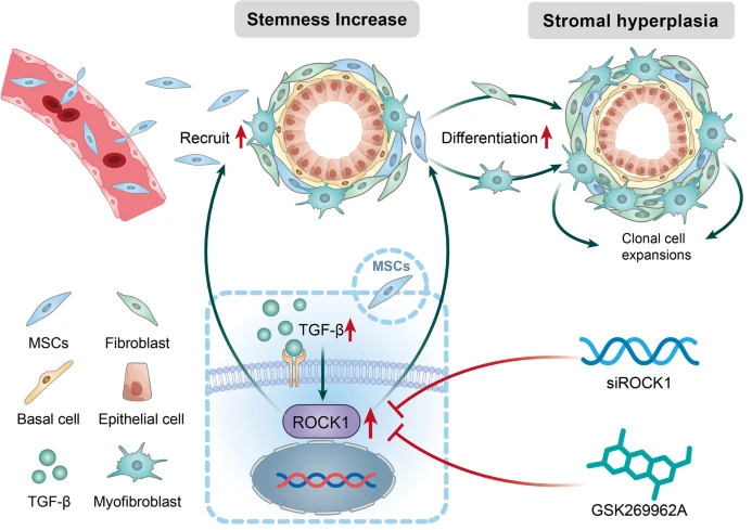 Researchers show that the aberrant activation of transforming growth factor β/ROCK1 increased the #stemness of benign prostatic hyperplasia (BPH) tissue by recruiting #MSCs, indicating the important role of embryonic reawakening in BPH. 📌 bit.ly/4baSYRk