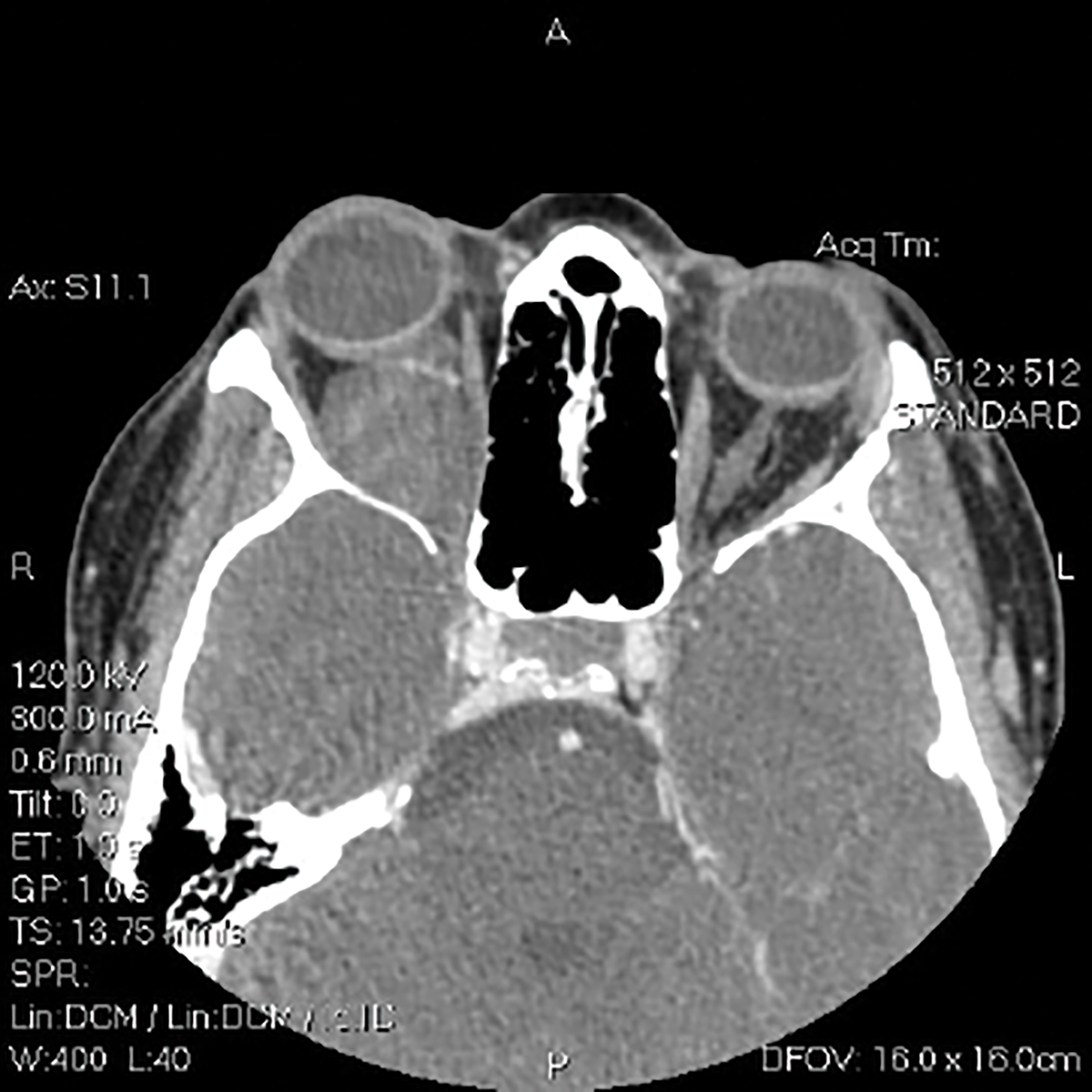 A Triad of Etiologies Complicates Diagnosis A child with monocular visual acuity reduction, significant hyperopic anisometropia and a constant unilateral strabismus in the same eye most likely has amblyopia. reviewofoptometry.com/article/a-tria… #optometry #optometrist #amblyopia #strabismus