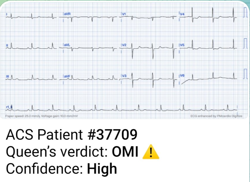 Answer: OMI signs detected ‼️‼️🚑🚑 1. Subtle STE <1mm in Lead 3 and aVF with reciprocal changes aVL and Lead 1 suggests Inferior OMI 2. Maximum STD in V2-V4 suggests Posterior Wall involvement. #ECG follow-up👇 #CardioTwitter #MedTwitter #MedX #medicalstudent @PMcardioApp
