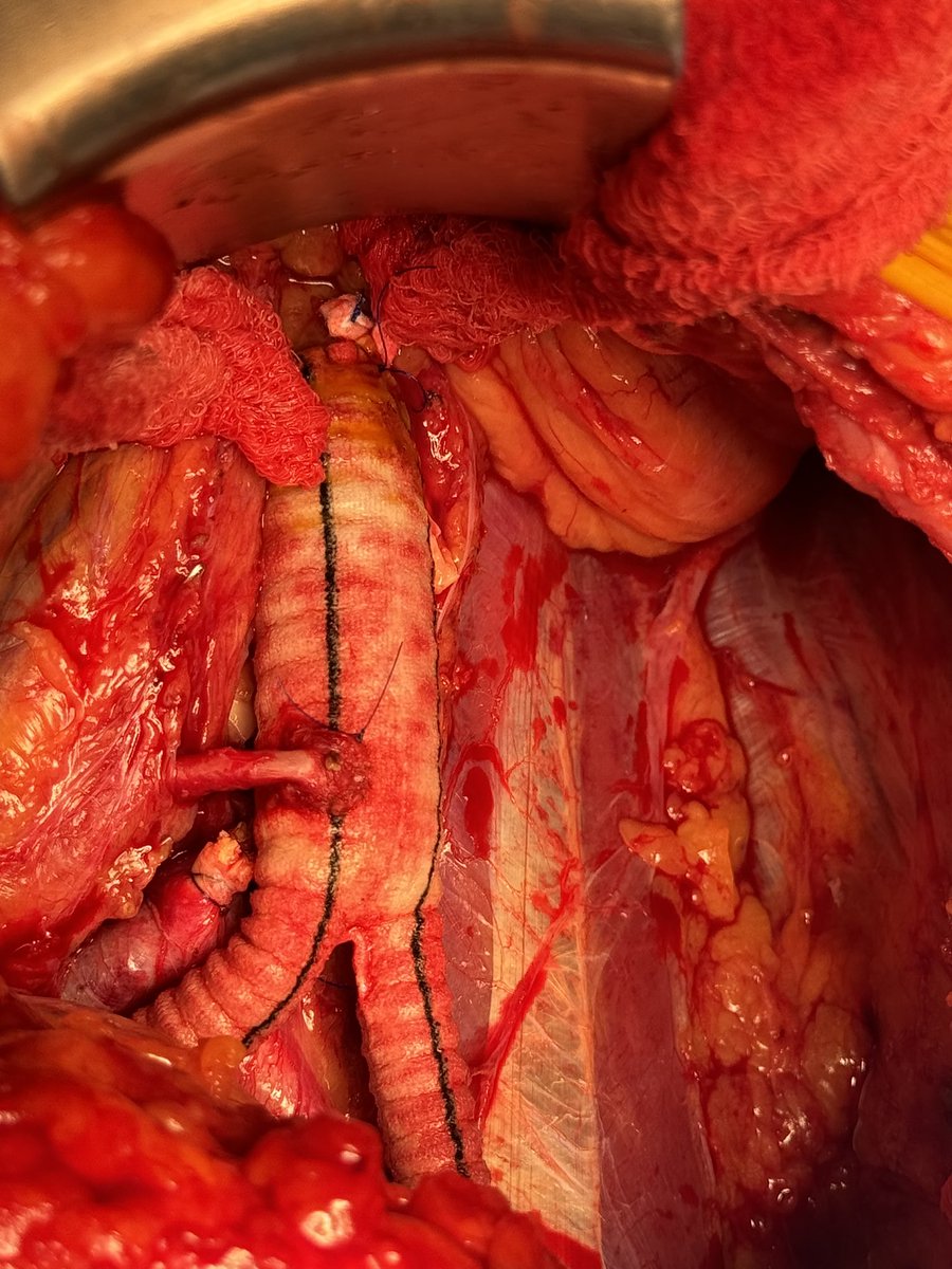 The final result will look like this. AFB following failed ENDO therapy with fem fem. Distal bifurcation small and oversewn IMA reimplanted. Retroperitoneal approach. No ribs removed. #Aorta replaced to left renal. #AortaEd