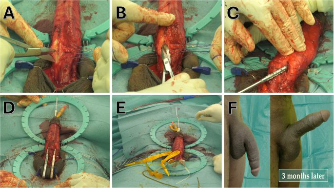 Early Inflatable #PenileProsthesis implantation offers superior outcomes compared to delayed insertion following ischemic #priapism👉rdcu.be/dHl43 @eliachawareb @faysal_a_yafi @dbarhammd @Mo_Moukhtar @babak_k_azad @OsmonovDr @rigiconurology @UCI_Urology