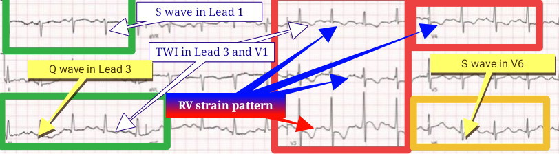 My first diagnosis is 🔺Acute PE✅ #ECG shows: 1. Sinus Tachycardia with HR ~120bpm 2. Kasuge - TWI in V1 and Lead 3 3. Tall R wave with STD and TWI in V1-V4 ~ RV strain pattern 4. S wave in V6- rotating vector to the right side; RV enlargement. 5. McGinn-White sign- S1Q3T3