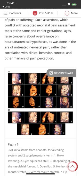 And if preborn babies did not feel pain, the American Academy of Pediatrics would not have to consider the 'Prevention and Management of Procedural Pain in the Neonate'.

publications.aap.org/pediatrics/art…

#abortion #AbolishAbortion