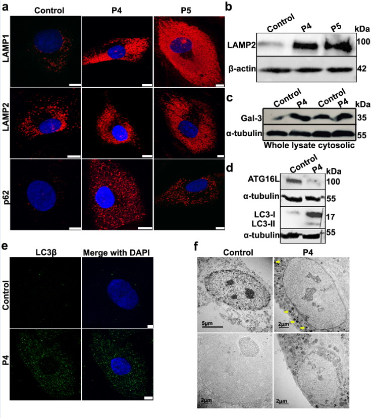GIMJournal's tweet image. New research reveals that biallelic mutations in #ZFTRAF1 are linked to a severe neurodevelopmental condition bit.ly/4b9YCDt @sajid_mhussain #Genetics #Neurodevelopment #mrnaprocessing #autophagy