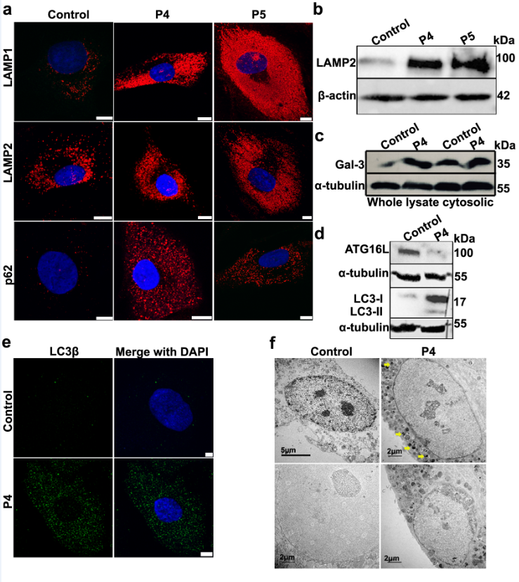 New research reveals that biallelic mutations in #ZFTRAF1 are linked to a severe neurodevelopmental condition bit.ly/4b9YCDt @sajid_mhussain #Genetics #Neurodevelopment #mrnaprocessing #autophagy