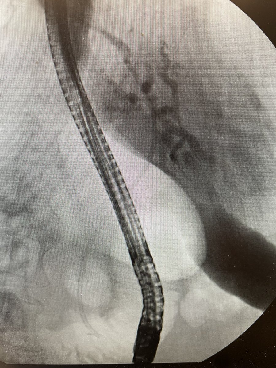 Severe left hepatic duct obstruction secondary to metastases. Left system accessed, dilated, and stented. #gitwitter #medtwitter