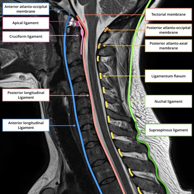 🔴CERVICAL SPINE LIGAMENTS🔴:
ALL,
PLL,
Apical lig,
Alar lig(s)(paired),
Cruciate lig of atlas,
Ant &Post Atlanto-occipital membranes,
Tectorial membrane,
Ligamentum flavum,
Ligamentum nuchae,
Interspinous, Intertransverse & Supraspinous ligaments.
 radiopaedia.org/articles/33022