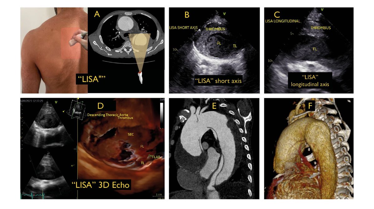 We published about this approach, possible even in patients without pleural effusion when there is dilatation of descending thoracic aorta (dissection for example), and we called LISA. @NMerke @ctinocomesquita ijcscardiol.org/article/a-new-… Thanks for sharing this beautiful case…