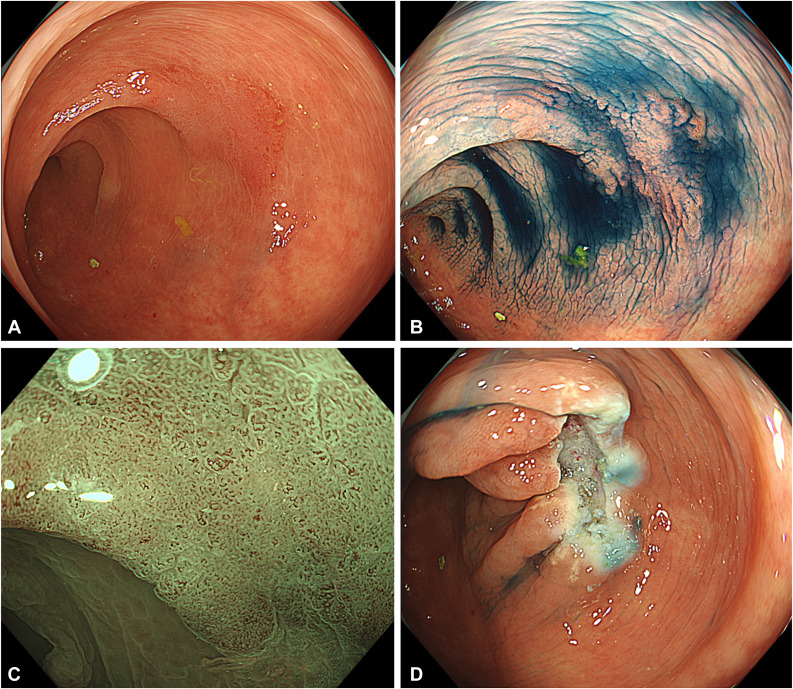 VideoGIE Editor's Choice: “Hot snare polypectomy using bipolar snare: an easy and feasible approach for intermediate-sized colorectal lesions” by Nobuhisa Minakata et al. videogie.org/article/S2468-…

@KaraRaphael