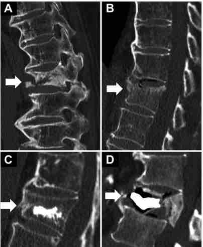 #FreeArticle: Examination of the prognostic factors of balloon kyphoplasty for osteoporotic vertebral fractures with diffuse idiopathic skeletal hyperostosis (DISH) thejns.org/spine/view/jou…