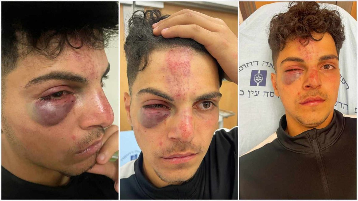 Meanwhile in the West Bank (where Hamas is absent), the settlers are continuing to prove that the only 'game' in the Israeli playbook is systematic ethnic cleansing of Palestinians. Meet Adam Al-Reshq , age 16, a Palestinian in the occupied West Bank. Beaten by settlers. Today.