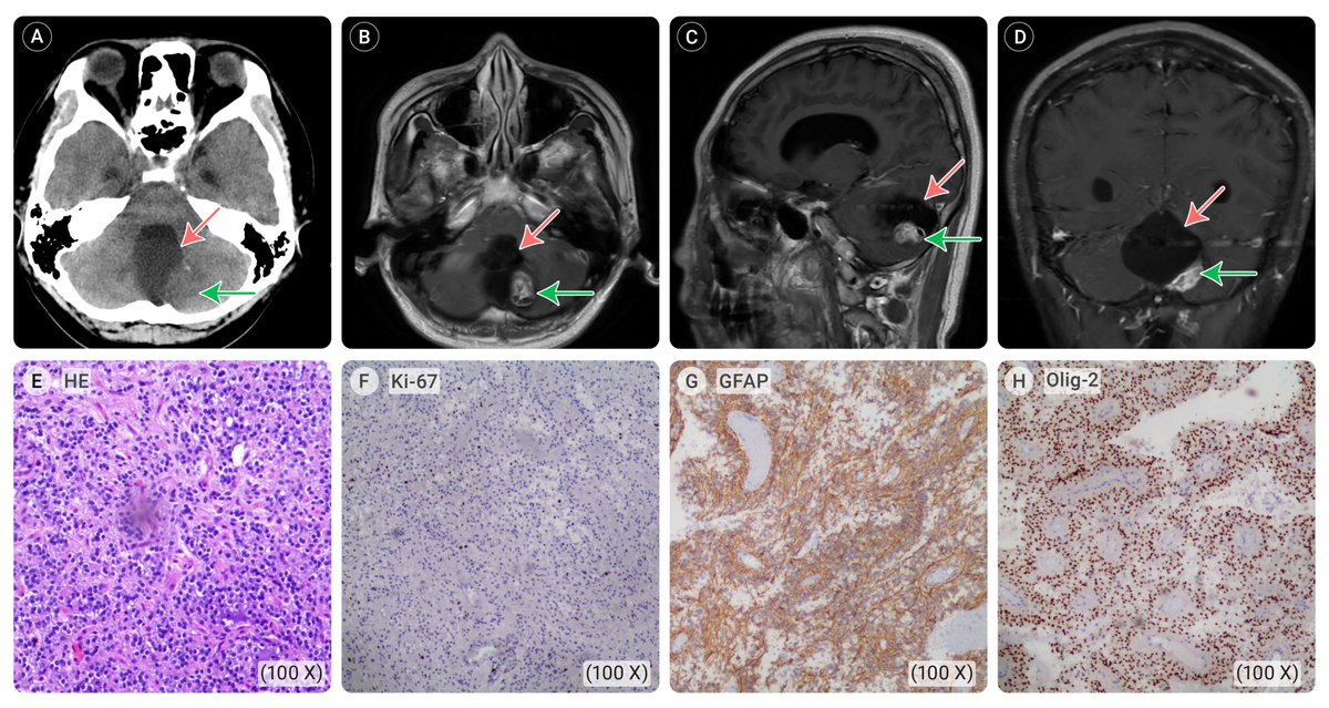 New in The Innovation Medicine! Gliomas and nephrotic syndrome: Coincidental comorbidity or pathogenic association? In this study, Yang et al. reported a case in which a 20-year-old male patient, who has a history of vitiligo and nephrotic syndrome, was diagnosed with an…