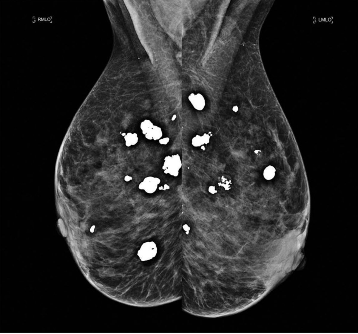 What is the breast diagnosis ?