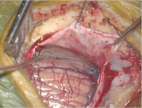 When would you use a U-shaped incision over a T-shaped incision in the tentorium for the excision of a posterior parahippocampal lesions?
Bonus: What nerve is protected along the edge of the tentorium?

 #MedTwitter #Neurosurgery #NSGY #surgery