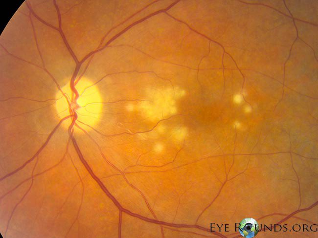 Dr. Glaucomflecken tweet media