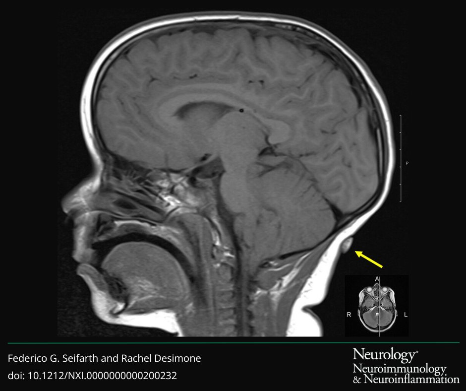 Tick paralysis should be suspected in all cases of acute ataxia, especially in children. Learn more: bit.ly/4bh2Usj #NeuroTwitter #Neurology