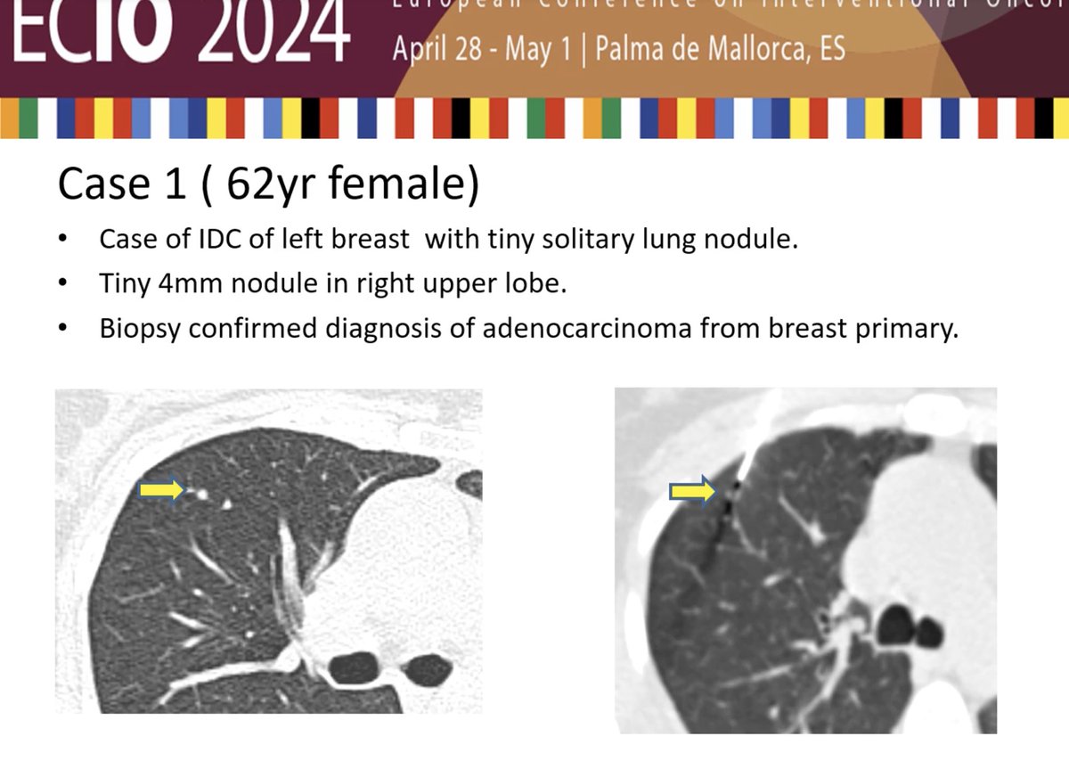 bharatgupta300's tweet photo. Subcentimeter sized lung nodules are a diagnostic dilemma especially in oncology patients.
Presented our data on CT guided biopsy of subcentimeter sized lung nodules in known malignancy patients at ECIO 2024.Out of 102 patients 49 had malignancy. Smallest size biopsied 4mm. #ECIO https://t.co/7HDI7d7dKk