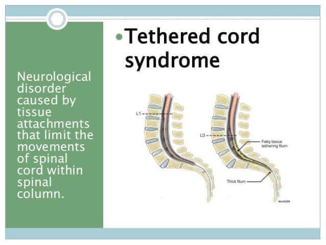Day 8 #SyringomyeliaAwareness Month
Posttraumatic syringomyelia involves development of a fluid-filled cavity (cyst/ syrinx) within the spinal cord following a spinal cord injury. Tethering or scarring of the spinal cord has been a pathophysiological cause for Syringomyelia.