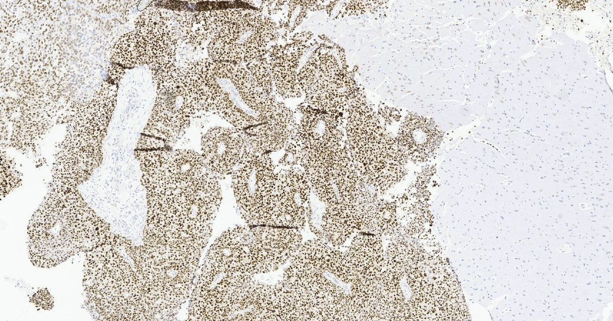 Metastatic urothelial carcinoma involving brain #gupath# GATA3 stain diffusely positive.