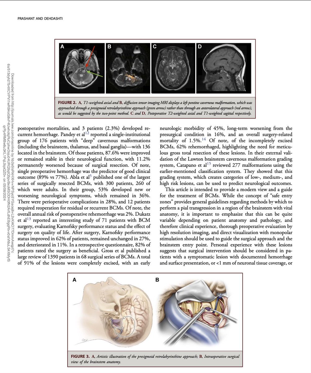 Novel approach selection for #brainstem Cavernous Malformation #cavmal based on #DTI fiber tracking, direct brainstem mapping and lab based safe entry zone evaluation. New technology has helped us to achieve best outcomes in these lesions @cvsection @NASBSorg @NeurosurgeryCNS