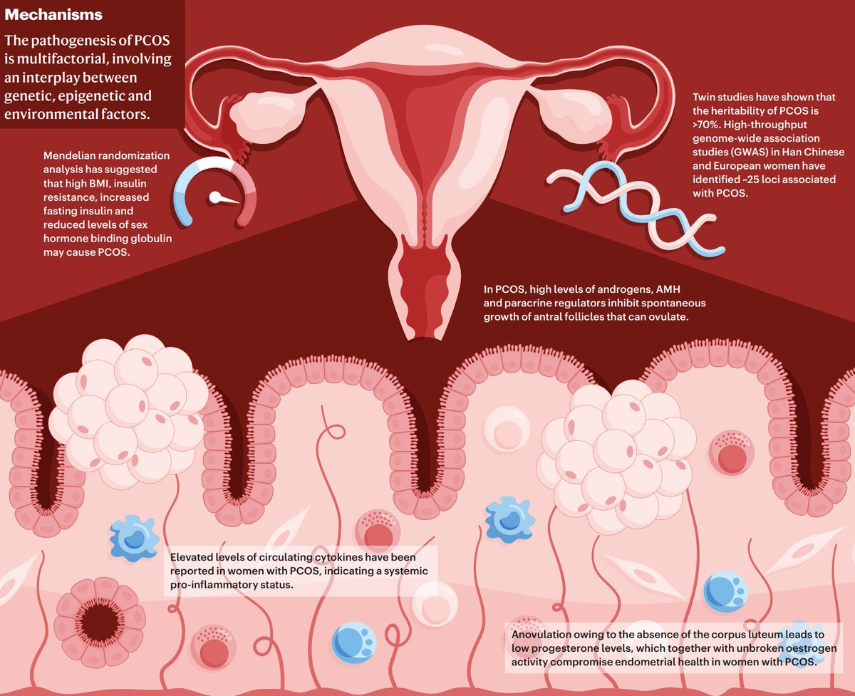 Le syndrome des ovaires polykystiques (SOPK) est un trouble hormonal complexe caractérisé par des signes d'androgènes élevés, de menstruations irrégulières et d'ovaires polykystiques

C’est la cause la plus fréquente de cycles menstruels irréguliers et d'infertilité anovulatoire