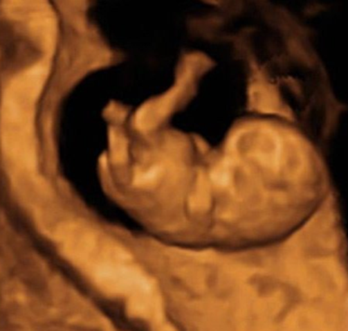 #TurnoSanMungo 

Se hace entrega de fotos de ultrasonido y vídeo de ambos corazones de feto A y feto B en vídeo para los padres.

Ultrasonido de apariencia única, 2D y 4D: 

+