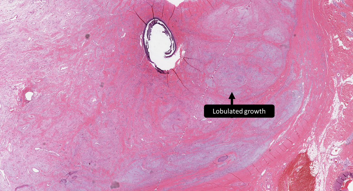 ___-myxoma is the cutaneous myxoma described in Carney complex. A) Superficial angio B) Aggressive angio C) Acral fibro D) Dermal nerve sheath #BSTPath #PathTwitter #Pathology #PediPath 📽️🔬🙏@JMGardnerMD dpa-dapa.com/public/display… youtu.be/chm6EIv9tFQ?si…