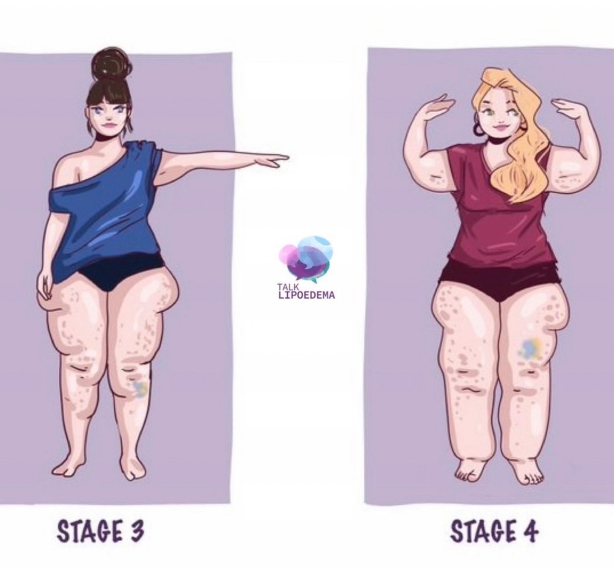 Do you have #lipoedema? here’s some  common symptoms: Large shaped legs, cuffs around ankles, Swollen legs that easily bruise + are painful to touch, Excess tissue gathered around knees and on inner thighs, Size doesn’t reduce with diet or exercise?? #lipedema #talklipoedema
